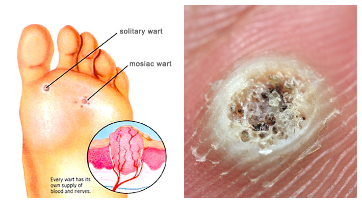 When is it a Callus and When is it a Wart?: Podiatry Hotline Foot & Ankle:  Foot and Ankle Specialists
