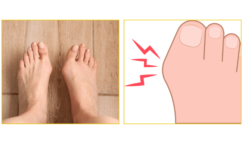Bunion treatment and foot pain relief at Chicago Foot Care Clinic