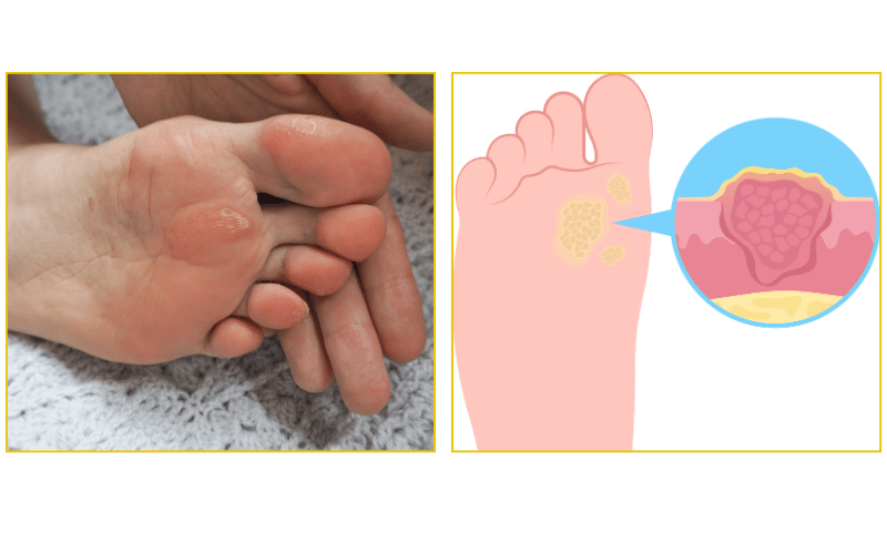 Professional corn and callus removal treatment at Chicago Foot Care Clinic