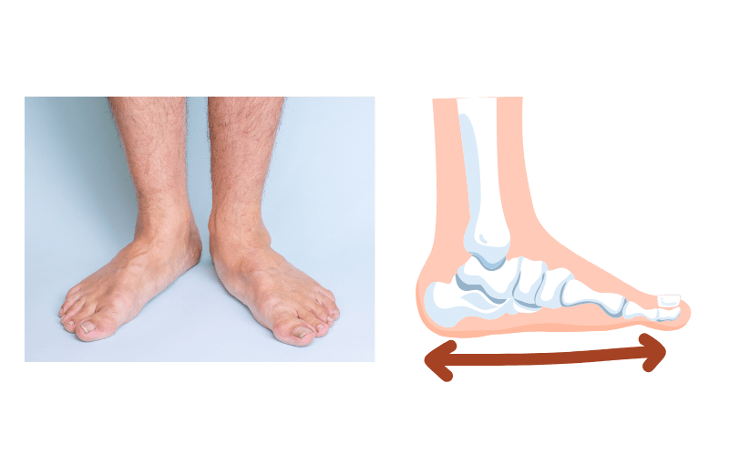 Advanced flat foot correction and custom arch support at Chicago Foot Care Clinic