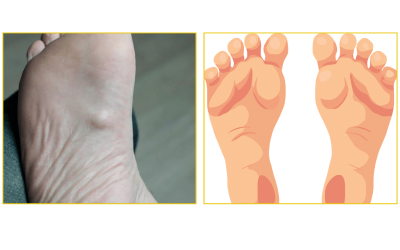 Foot arch and ball of foot pain treatment at Chicago Foot Care Clinic