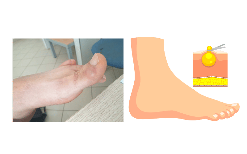 Minimally invasive foot cyst removal treatment at Chicago Foot Care Clinic