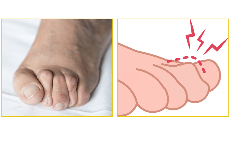 Hammertoe treatment and toe alignment at Chicago Foot Care Clinic