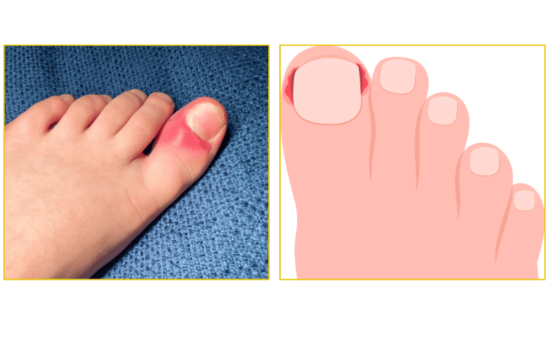 Ingrown toenail treatment and gentle removal at Chicago Foot Care Clinic