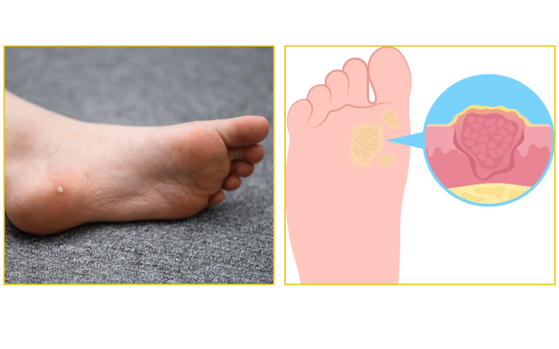 Plantar wart removal and foot skin treatment at Chicago Foot Care Clinic