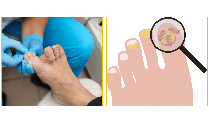 Toenail fungus treatment and clear nail laser therapy at Chicago Foot Care Clinic